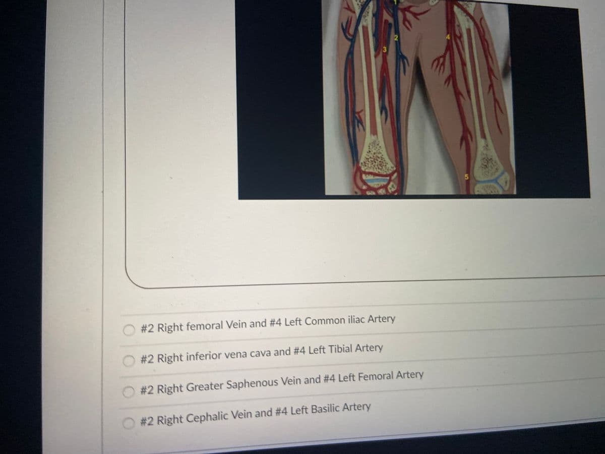 #2 Right femoral Vein and #4 Left Common iliac Artery
#2 Right inferior vena cava and #4 Left Tibial Artery
#2 Right Greater Saphenous Vein and #4 Left Femoral Artery
#2 Right Cephalic Vein and #4 Left Basilic Artery
