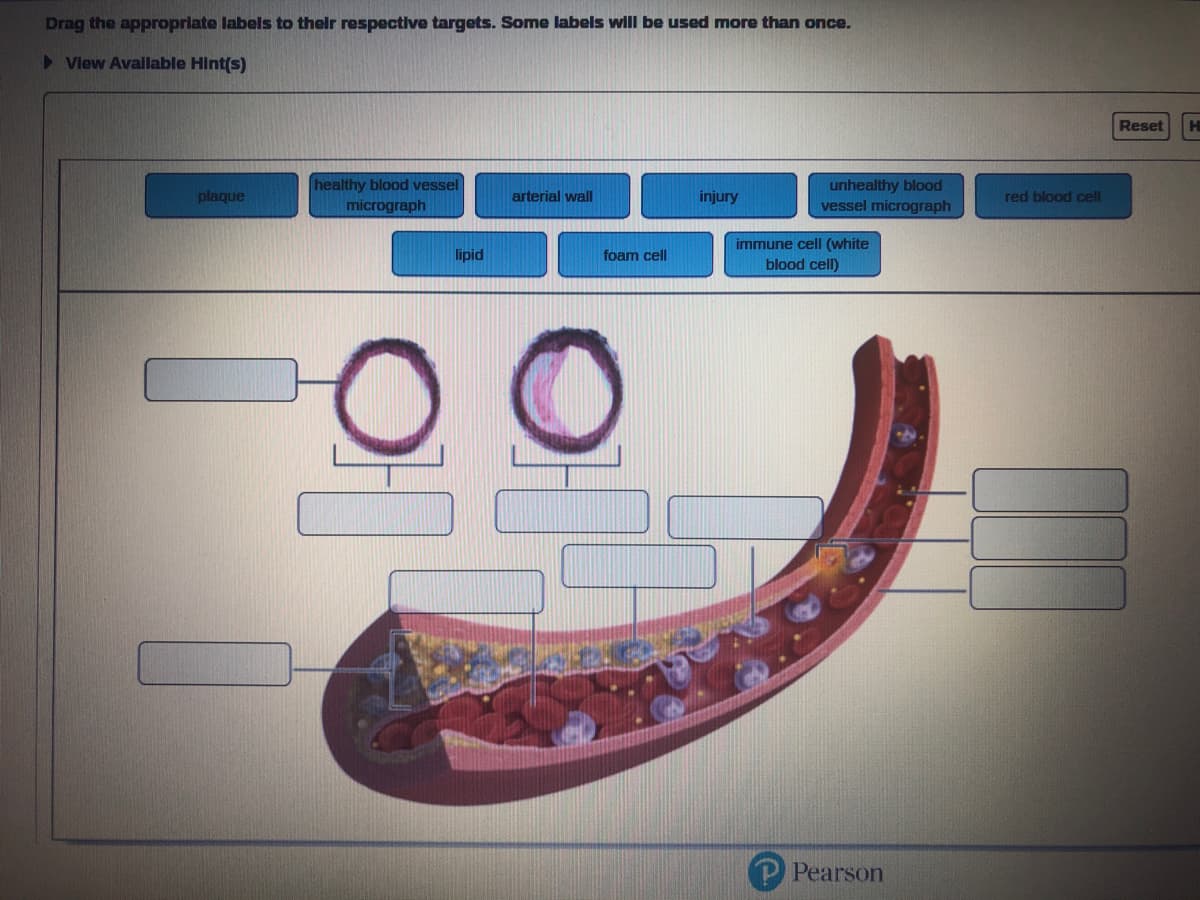 Drag the appropriate labels to their respective targets. Some labels will be used more than once.
► View Available Hint(s)
plaque
healthy blood vessel
micrograph
arterial wall
injury
o
lipid
foam cell
unhealthy blood
vessel micrograph
immune cell (white
blood cell)
P Pearson
red blood cell
Reset H