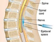 Spine
Spinal
cord
Nerve
Epidural
space
