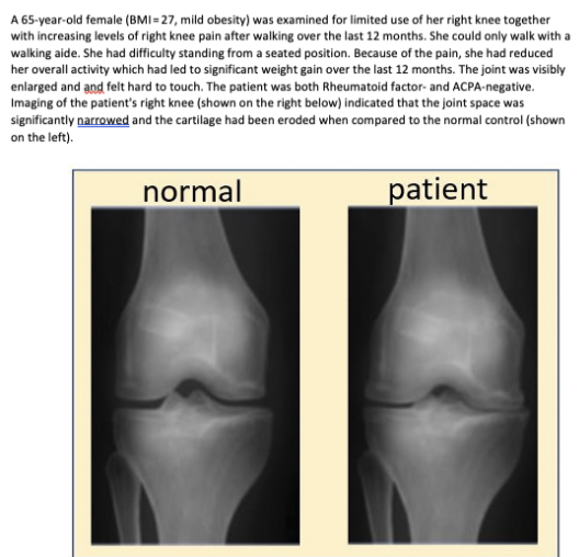 A 65-year-old female (BMI=27, mild obesity) was examined for limited use of her right knee together
with increasing levels of right knee pain after walking over the last 12 months. She could only walk with a
walking aide. She had difficulty standing from a seated position. Because of the pain, she had reduced
her overall activity which had led to significant weight gain over the last 12 months. The joint was visibly
enlarged and and felt hard to touch. The patient was both Rheumatoid factor- and ACPA-negative.
Imaging of the patient's right knee (shown on the right below) indicated that the joint space was
significantly narrowed and the cartilage had been eroded when compared to the normal control (shown
on the left).
normal
patient