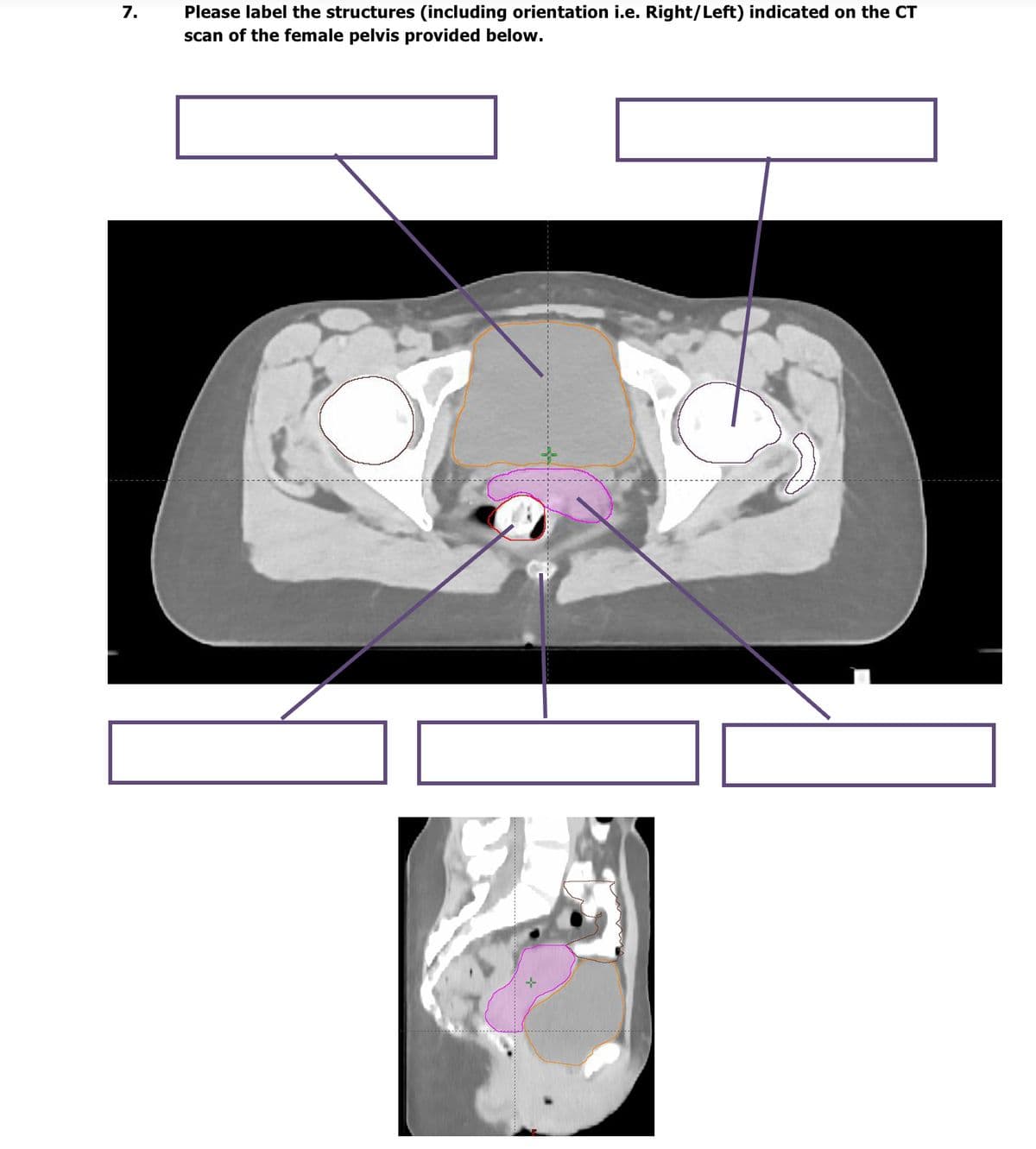7.
Please label the structures (including orientation i.e. Right/Left) indicated on the CT
scan of the female pelvis provided below.