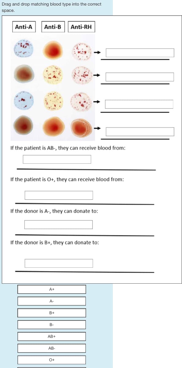 Drag and drop matching blood type into the correct
space.
Anti-A Anti-B Anti-RH
If the patient is AB-, they can receive blood from:
If the patient is O+, they can receive blood from:
If the donor is A-, they can donate to:
If the donor is B+, they can donate to:
A+
A-
B+
B-
AB+
AB-
O+