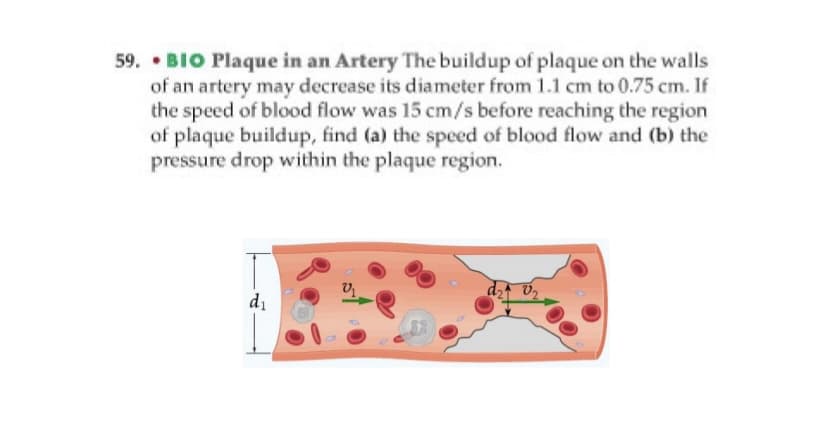 59. • BIO Plaque in an Artery The buildup of plaque on the walls
of an artery may decrease its diameter from 1.1 cm to 0.75 cm. If
the speed of blood flow was 15 cm/s before reaching the region
of plaque buildup, find (a) the speed of blood flow and (b) the
pressure drop within the plaque region.
di
