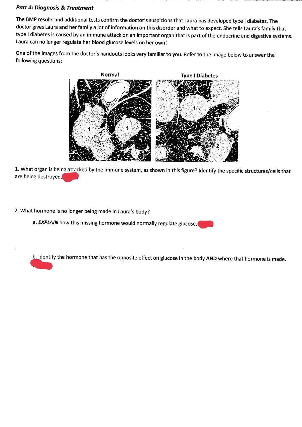 Part 4: Diagnosis & Treatment
The BMP results and additional tests confirm the doctor's suspicions that Laura has developed type I diabetes. The
doctor gives Laura and her family a lot of information on this disorder and what to expect. She tells Laura's family that
type I diabetes is caused by an immune attack on an important organ that is part of the endocrine and digestive systems.
Laura can no longer regulate her blood glucose levels on her own!
One of the images from the doctor's handouts looks very familiar to you. Refer to the image below to answer the
following questions:
Normal
Type I Diabetes
1. What organ is being attacked by the immune system, as shown in this figure? Identify the specific structures/cells that
are being destroyed.
2. What hormone is no longer being made in Laura's body?
a. EXPLAIN how this missing hormone would normally regulate glucose.
b. Identify the hormone that has the opposite effect on glucose in the body AND where that hormone is made.