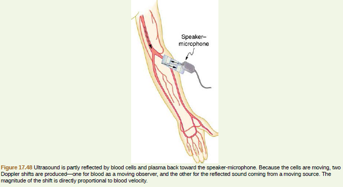 Speaker-
microphone
Figure 17.48 Ultrasound is partly reflected by blood cells and plasma back toward the speaker-microphone. Because the cells are moving, two
Doppler shifts are produced-one for blood as a moving observer, and the other for the reflected sound coming from a moving source. The
magnitude of the shift is directly proportional to blood velocity.
