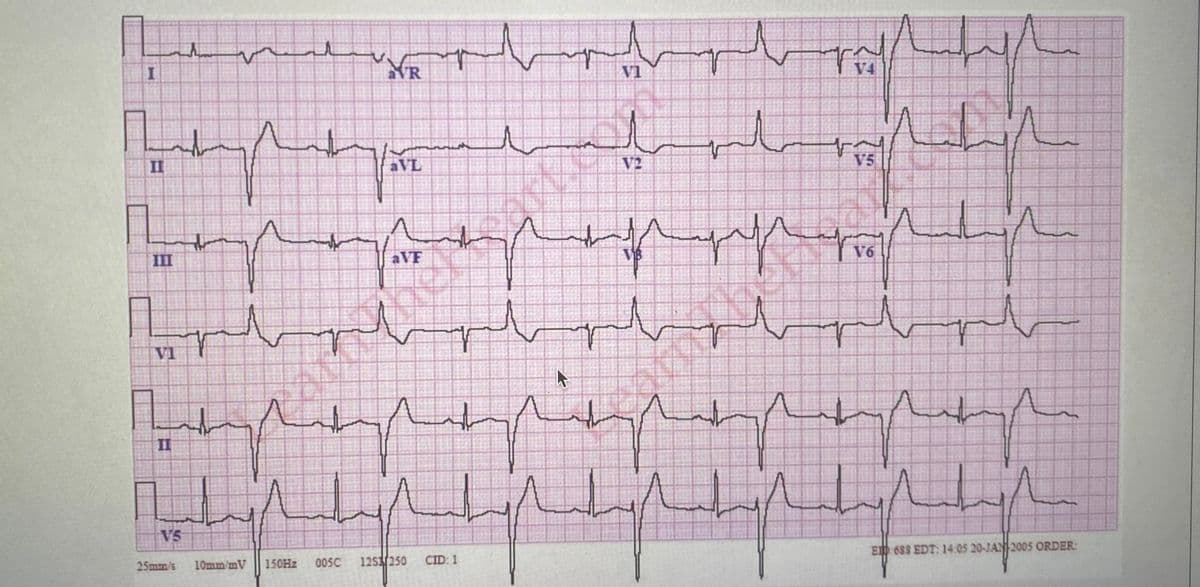 aVR
Vi
V4
II
aVL
V2
V5
III
aVF
VB
V6
V1
II
V5
ElD 688 EDT: 14 05 20-JAN 2005 ORDER:
25mm/s
10mm mV
150H2
005C
12S250
CID: 1
