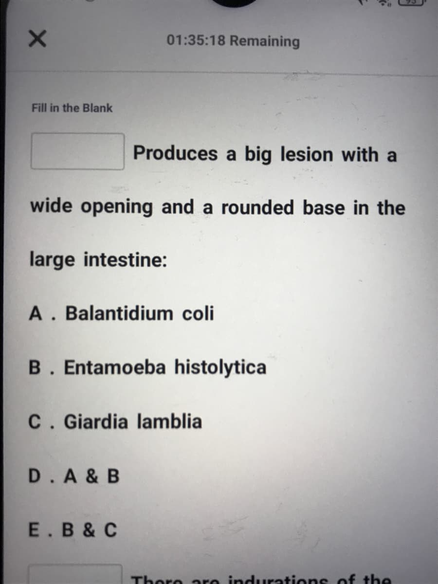 01:35:18 Remaining
Fill in the Blank
Produces a big lesion with a
wide opening and a rounded base in the
large intestine:
A. Balantidium coli
B. Entamoeba histolytica
C. Giardia lamblia
D.A & B
E.B &C
Thoro are indurations of the

