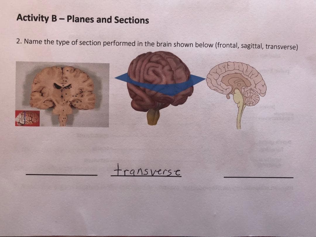 Activity B-Planes and Sections
2. Name the type of section performed in the brain shown below (frontal, sagittal, transverse)
transverst

