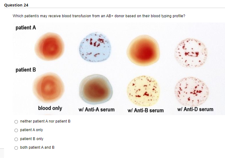 Question 24
Which patient/s may receive blood transfusion from an AB+ donor based on their blood typing profile?
patient A
patient B
blood only
wl Anti-A serum
wl Anti-B serum
wl Anti-D serum
neither patient A nor patient B
patient A only
patient B only
both patient A and B
