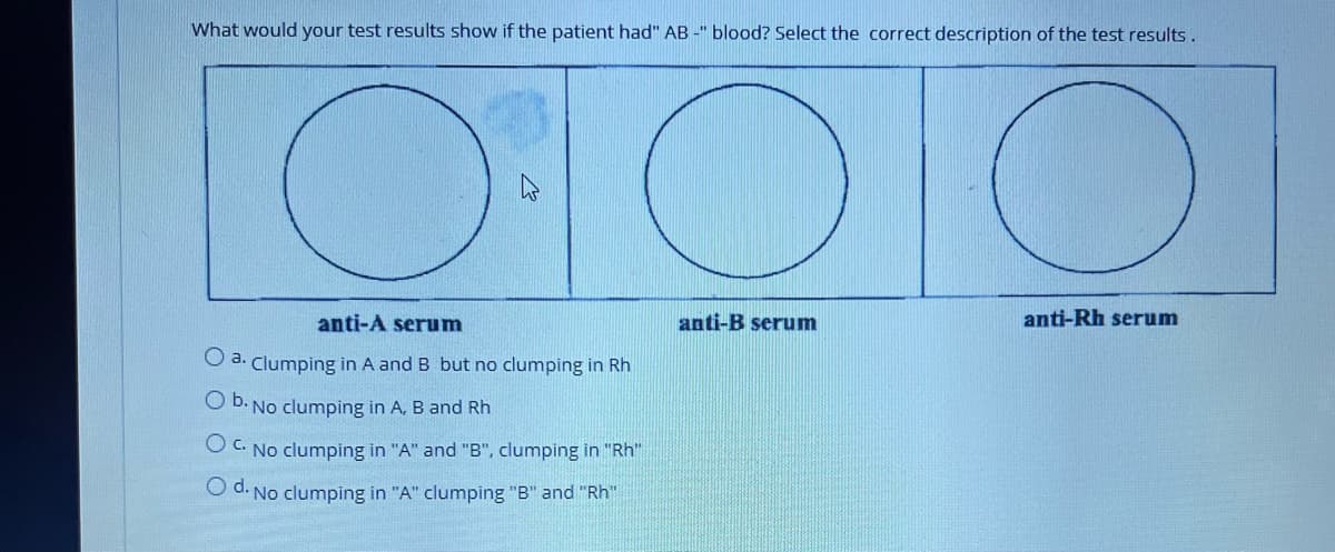 What would your test results show if the patient had" AB -" blood? Select the correct description of the test results.
anti-A serum
anti-B serum
anti-Rh serum
O a. Clumping in A and B but no clumping in Rh
O b. No clumping in A, B and Rh
O C. No clumping in "A" and "B", clumping in "Rh"
O d. No clumping in "A" clumping "B" and "Rh"
