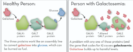 Healthy Person:
Galactose
GALKI
protein
GALT
protein
Glucose
GALE
protein
The three proteins work like an assembly line
to convert galactose into glucose, which can
be burned as fuel.
Person with Galactosemia:
Galactose
GALKI
GALE
Altered
protein GALT protein protein
A problem with any one of these proteins (and
the gene that codes for it) causes galactosemia.
Galactose builds up to harmful levels.