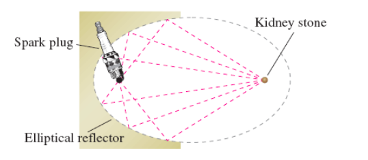 Kidney stone
Spark plug
Elliptical reflector
