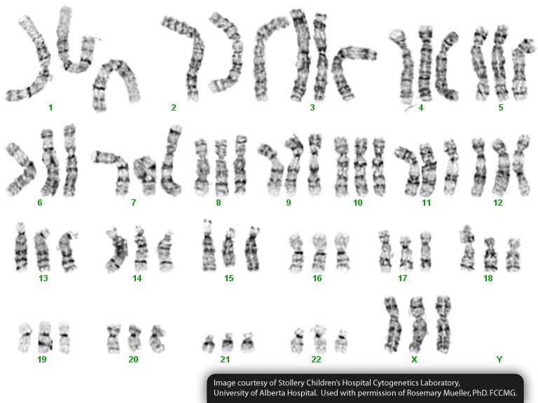 2
3
6
8
10
11
12
自》
13
14
15
16
17
18
19
20
21
22
Image courtesy of Stollery Children's Hospital Cytogenetics Laboratory,
University of Alberta Hospital. Used with permission of Rosemary Mueller, PhD. FCCMG.
9
