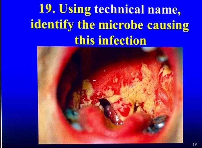 19. Using technical name,
identify the microbe causing
this infection
19
