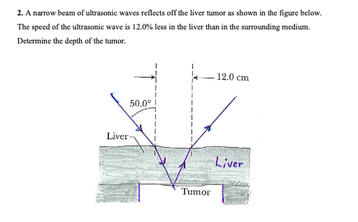 2. A narrow beam of ultrasonic waves reflects off the liver tumor as shown in the figure below.
The speed of the ultrasonic wave is 12.0% less in the liver than in the surrounding medium.
Determine the depth of the tumor.
12.0 cm
50.0°
Liver
Liver
Tumor
