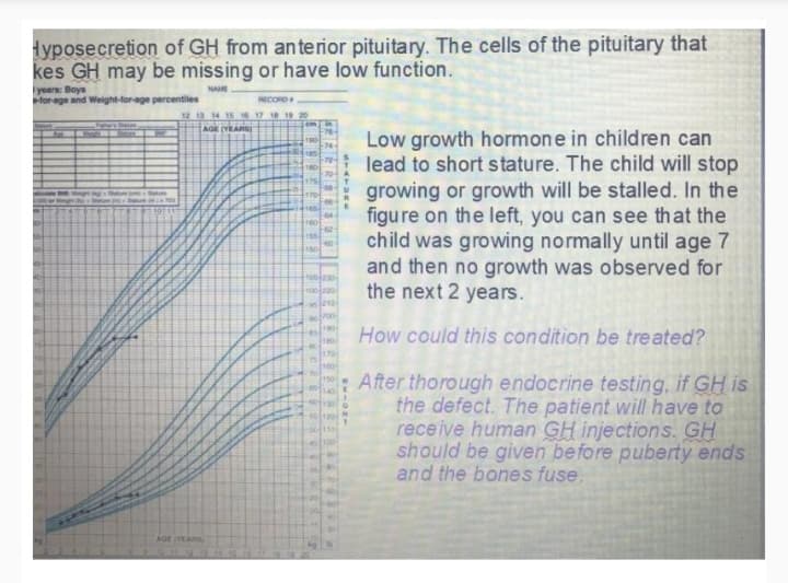 Hyposecretion of GH from anterior pituitary. The cells of the pituitary that
kes GH may be missing or have low function.
years Boys
for ege and Weight-for-age percentiles
NAME
RECORD
12 13 14 15 16 17 18 19
AGE (YEARS)
Low growth hormone in children can
lead to short stature. The child will stop
growing or growth will be stalled. In the
figure on the left, you can see that the
child was growing normally until age 7
and then no growth was observed for
the next 2 years.
105230-
100220
How could this condition be treated?
After thorough endocrine testing, if GH is
the defect. The patient will have to
receive human GH injections. GH
should be given before puberty ends
and the bones fuse.
AG YEARS
