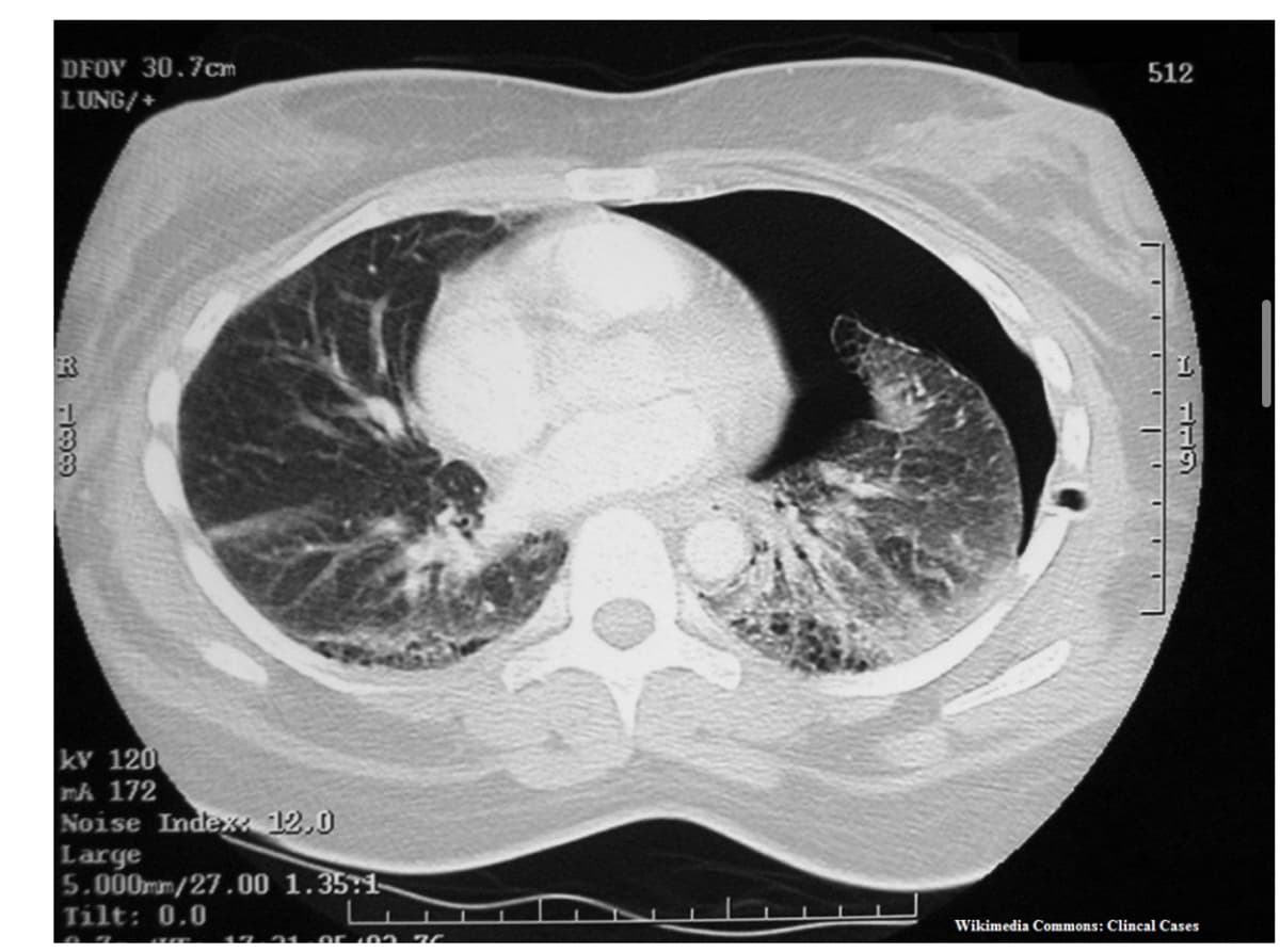 DFOV 30.7cm
LUNG/+
188
kv 120
mA 172
Noise Index: 12,0
Large
5.000mm/27.00 1.35:1-
Tilt: 0.0
L
17.21. 95 93 76
512
A TER
Wikimedia Commons: Clincal Cases