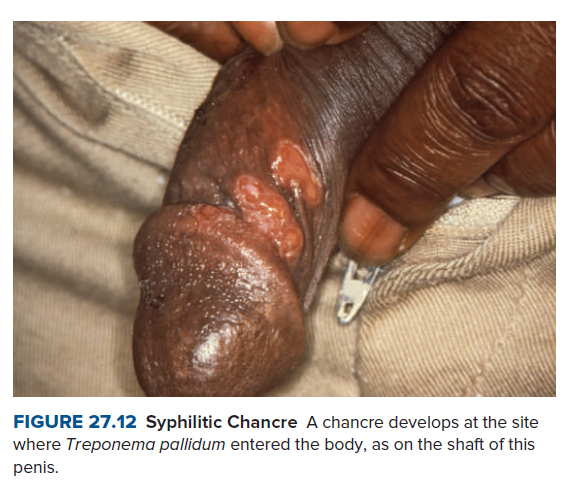 FIGURE 27.12 Syphilitic Chancre A chancre develops at the site
where Treponema pallidum entered the body, as on the shaft of this
penis.
