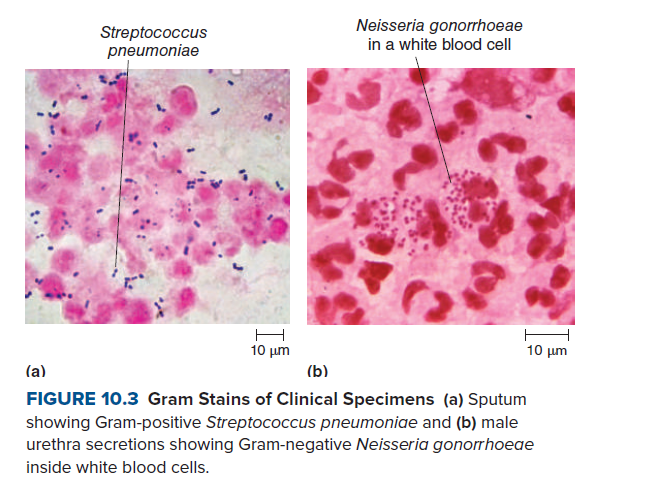 Streptococcus
pneumoniae
Neisseria gonorrhoeae
in a white blood cell
H
10 μη
10 μη
(a)
(b)
FIGURE 10.3 Gram Stains of Clinical Specimens (a) Sputum
showing Gram-positive Streptococcus pneumoniae and (b) male
urethra secretions showing Gram-negative Neisseria gonorrhoeae
inside white blood cells.
