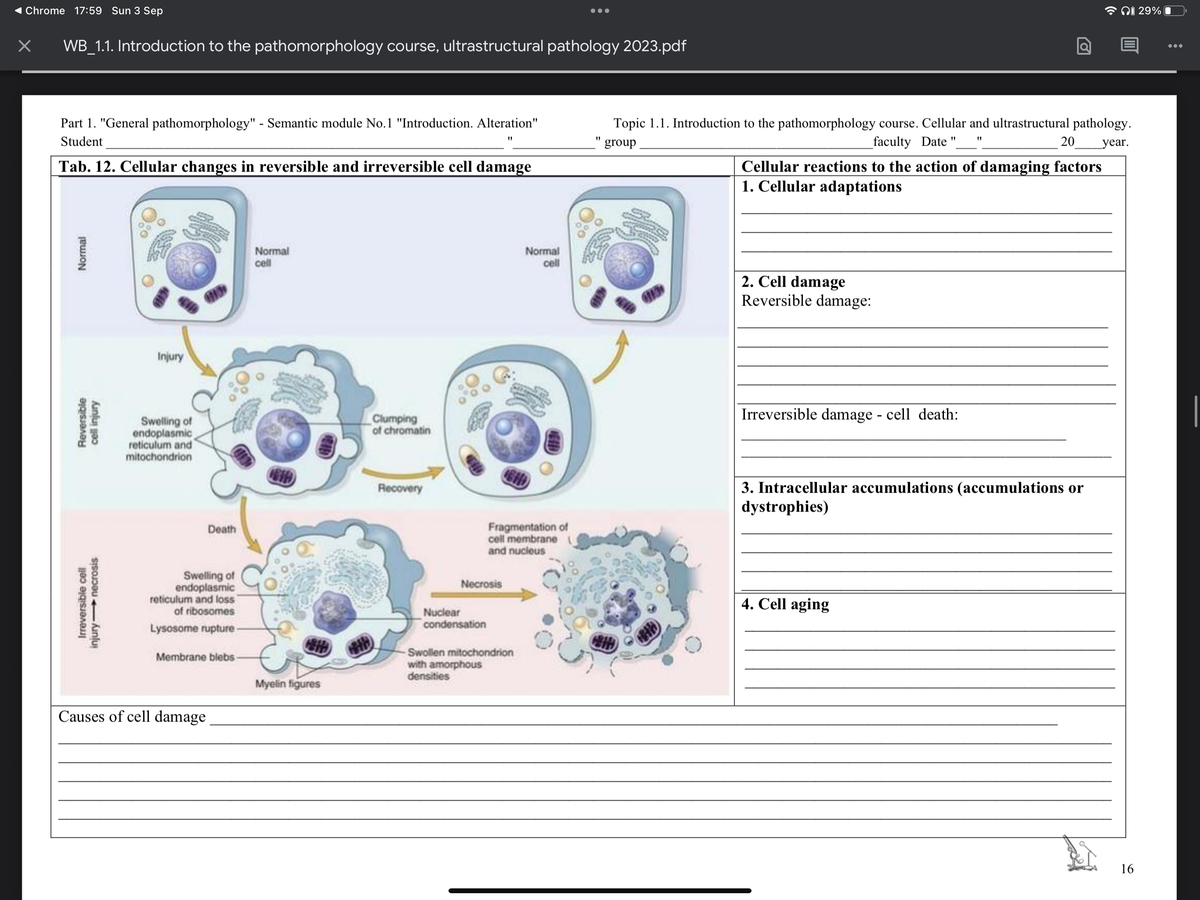 ◄ Chrome 17:59 Sun 3 Sep
× WB_1.1. Introduction to the pathomorphology course, ultrastructural pathology 2023.pdf
Part 1. "General pathomorphology" - Semantic module No.1 "Introduction. Alteration"
Student
Tab. 12. Cellular changes in reversible and irreversible cell damage
Normal
Reversible
cell injury
Irreversible cell
injury-necrosis
Injury
Swelling of
endoplasmic
reticulum and
mitochondrion
Death
Swelling of
endoplasmic
reticulum and loss
of ribosomes
Lysosome rupture-
Membrane blebs-
Causes of cell damage
Normal
cell
1819
Myelin figures
Clumping
of chromatin
Recovery
Necrosis
Nuclear
condensation
Fragmentation of
cell membrane
and nucleus
Normal
cell
-Swollen mitochondrion
with amorphous
densities
Topic 1.1. Introduction to the pathomorphology course. Cellular and ultrastructural pathology.
group
faculty Date "
20 year.
Cellular reactions to the action of damaging factors
1. Cellular adaptations
2. Cell damage
Reversible damage:
a
Irreversible damage - cell death:
3. Intracellular accumulations (accumulations or
dystrophies)
4. Cell aging
16
29%