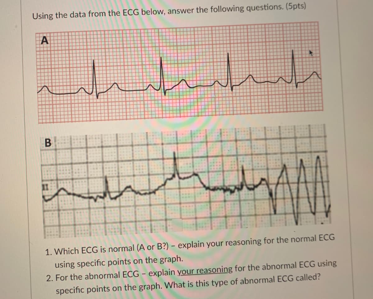 Using the data from the ECG below, answer the following questions. (5pts)
A
B
1. Which ECG is normal (A or B?) – explain your reasoning for the normal ECG
using specific points on the graph.
2. For the abnormal ECG - explain your reasoning for the abnormal ECG using
specific points on the graph. What is this type of abnormal ECG called?
