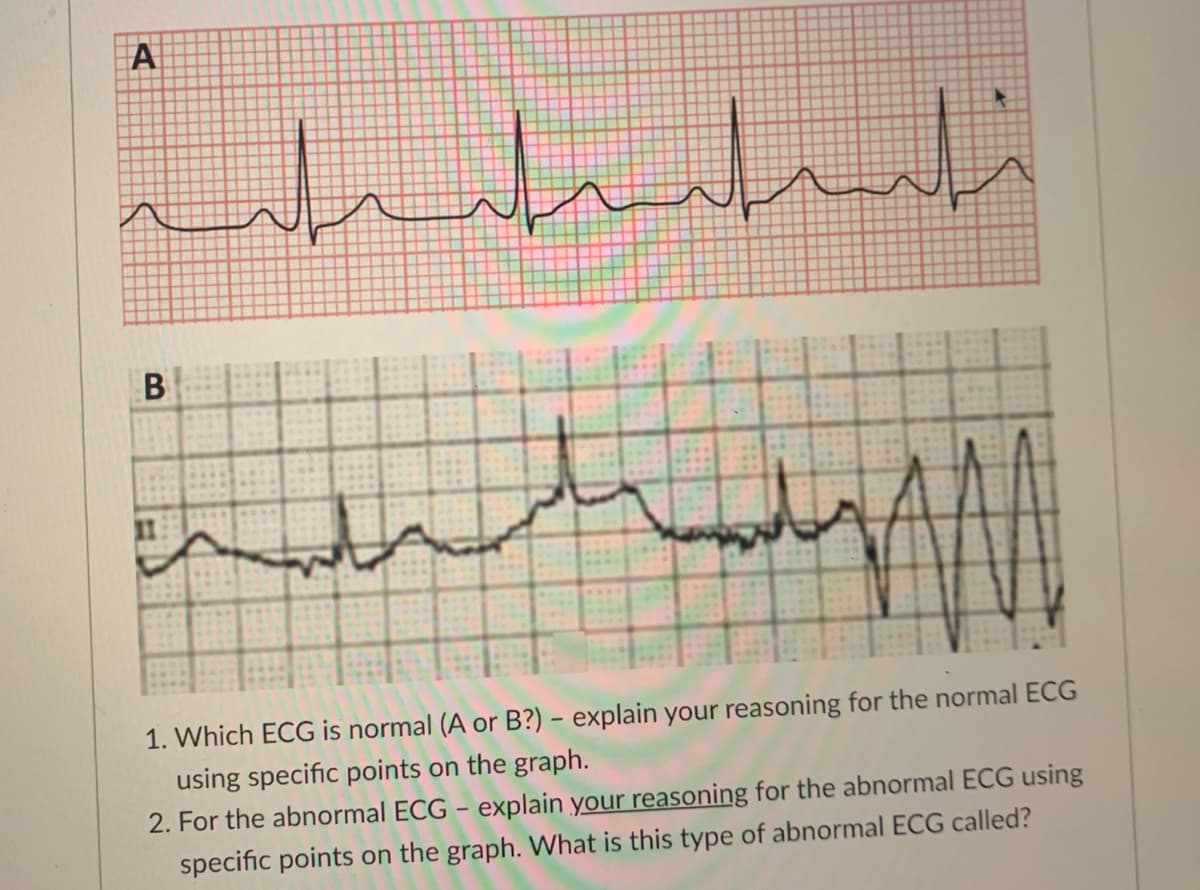 A
B
1. Which ECG is normal (A or B?) – explain your reasoning for the normal ECG
using specific points on the graph.
2. For the abnormal ECG - explain your reasoning for the abnormal ECG using
specific points on the graph. What is this type of abnormal ECG called?
