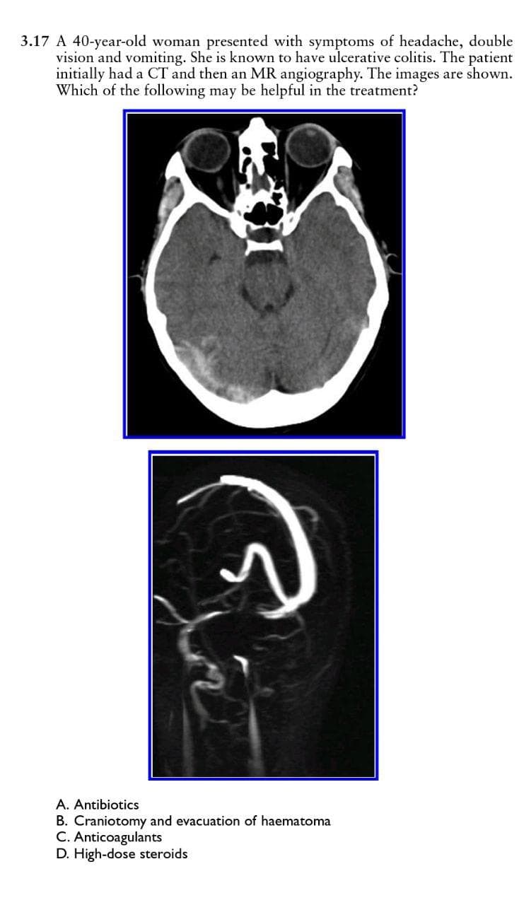 3.17 A 40-year-old woman presented with symptoms of headache, double
vision and vomiting. She is known to have ulcerative colitis. The patient
initially had a CT and then an MR angiography. The images are shown.
Which of the following may be helpful in the treatment?
A. Antibiotics
B. Craniotomy and evacuation of haematoma
C. Anticoagulants
D. High-dose steroids
