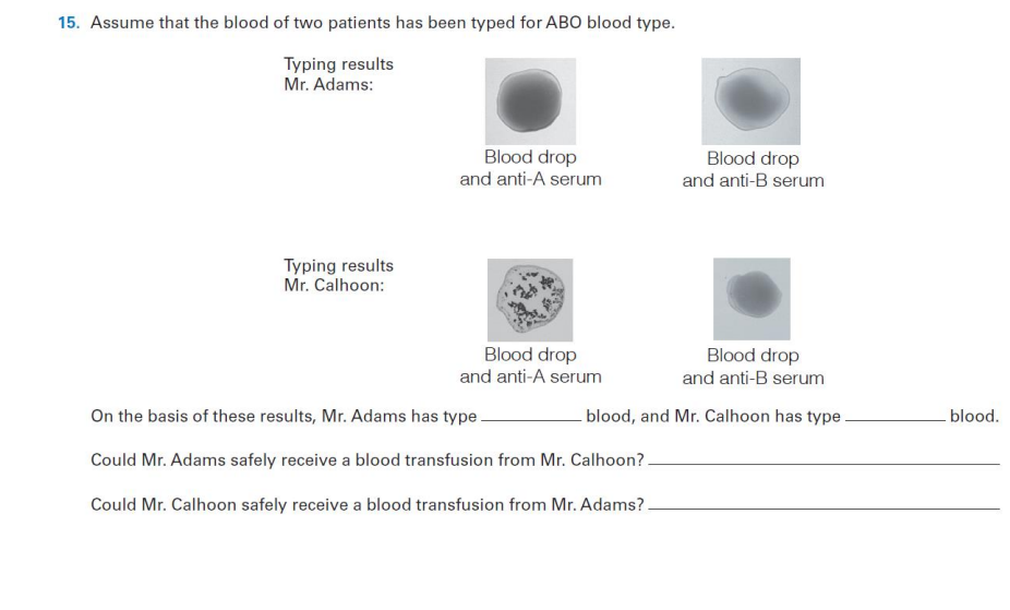 15. Assume that the blood of two patients has been typed for ABO blood type.
Typing results
Mr. Adams:
Blood drop
and anti-A serum
Blood drop
and anti-B serum
Typing results
Mr. Calhoon:
Blood drop
and anti-A serum
Blood drop
and anti-B serum
On the basis of these results, Mr. Adams has type.
blood, and Mr. Calhoon has type
blood.
Could Mr. Adams safely receive a blood transfusion from Mr. Calhoon?-
Could Mr. Calhoon safely receive a blood transfusion from Mr. Adams?.
