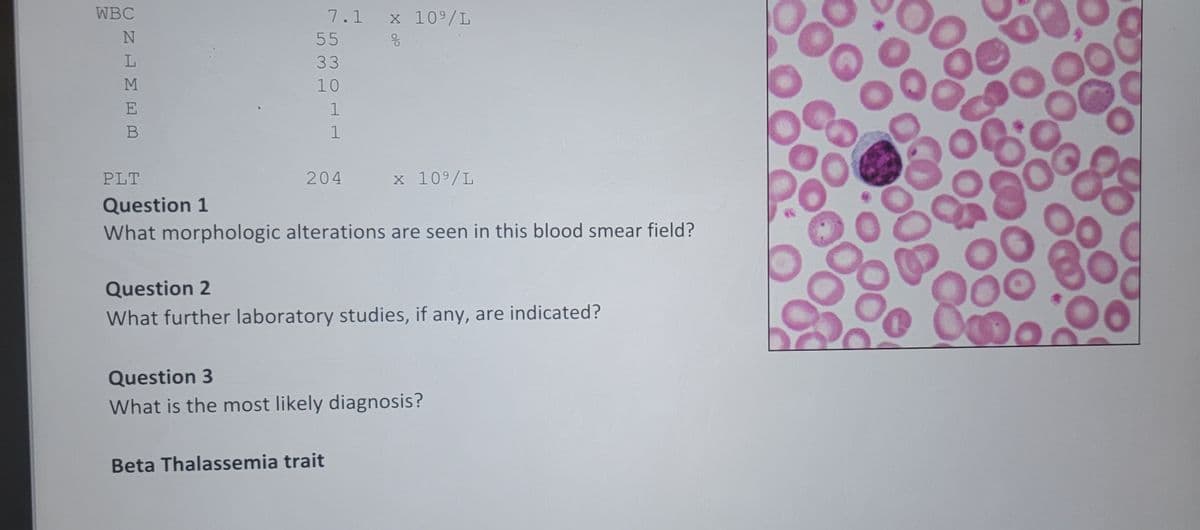 WBC
ΟΖΗΣΕΩ
N
L
M
E
B
7.1 x 10⁹/L
응
55
33
10
1
1
204
PLT
Question 1
What morphologic alterations are seen in this blood smear field?
Beta Thalassemia trait
x 10⁹/L
Question 2
What further laboratory studies, if any, are indicated?
Question 3
What is the most likely diagnosis?