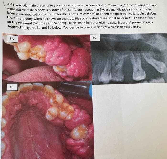 A 41-year old male presents to your rooms with a main complaint of: "I am here for these lumps that are
worrying me." He reports a history of these "lumps" appearing 5 years ago, disappearing after having
been given medication by his doctor (he is not sure of what) and then reappearing. He is not in pain but
there is bleeding when he chews on the side. His social history reveals that he drinks 8-12 cans of beer
on the weekend (Saturday and Sunday). He claims to be otherwise healthy. Intra-oral presentation is
depicted in Figures 3a and 3b below. You decide to take a periapical which is depicted in 3c.
ЗА
30
ЗВ
