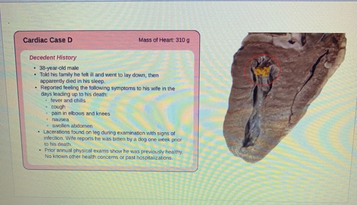 Cardiac Case D
Mass of Heart: 310 g
Decedent History
38-year-old male
• Told his family he felt ill and went to lay down, then
apparently died in his sleep.
• Reported feeling the following symptoms to his wife in the
days leading up to his death:
* fever and chills
cough
pain in elbows and knees
a nausea
Swollen abdormen
• Lacerations found on leg during examination with signs of
infection. Wife reports he was bitten by a dog one week prior
to his death.
Prior annual physical exams show he was previously healithy.
No known other health concems or past hospitalizations.

