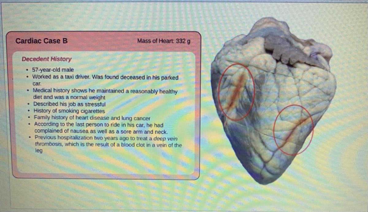 Cardiac Case B
Mass of Heart 332 g
Decedent History
57-year-old male
• Worked as a taxi driver. Was found deceased in his parked
car.
• Medical history shows he maintained a reasonably healthy
diet and was a normal weight
Described his job as stressful
History of smoking cigarettes
Family history of heart disease and lung cancer
• According to the last person to ride in his car, he had
complained of nausea as well as a sore arm and neck.
Previous hospitalization two years ago to treat a deep vein
thrombosis, which is the result of a blood clot in a vein of the
leg
