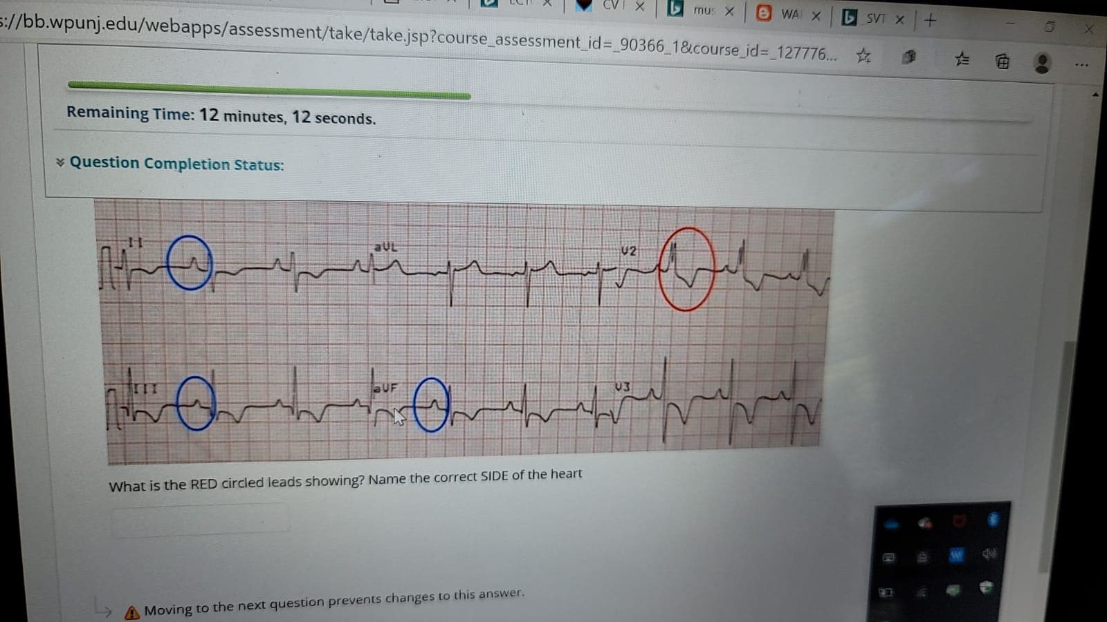 aUL
U2
aUF
What is the RED circled leads showing? Name the correct SIDE of the heart
