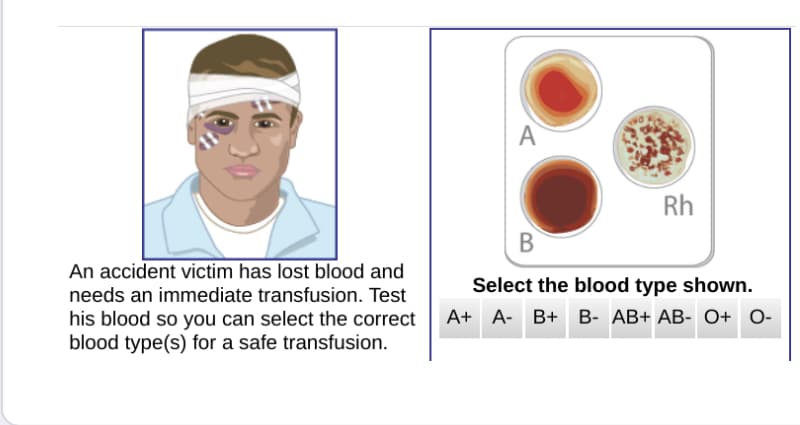Rh
В
An accident victim has lost blood and
Select the blood type shown.
needs an immediate transfusion. Test
А+ А- В+ В- АВ+ АВ- О+ О-
his blood so you can select the correct
blood type(s) for a safe transfusion.
A,
