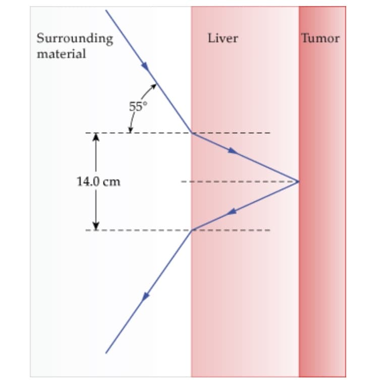 Surrounding
material
Liver
Tumor
55°
14.0 cm
