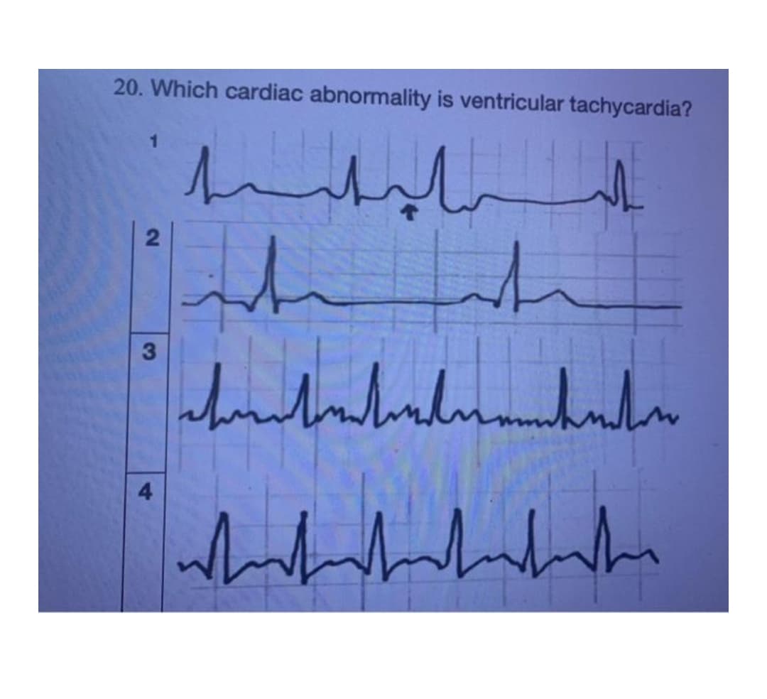 20. Which cardiac abnormality is ventricular tachycardia?
4
2.
