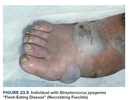 FIGURE 23.5 Individual with Streptococcus pyogenes
"Flesh-Eating Disease" (Necrotizing Fasciitis)
