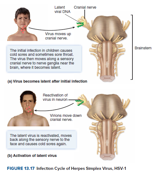 Latent
Cranial nerve
viral DNA
Virus moves up
cranial nerve.
Brainstem
The initial infection in children causes
cold sores and sometimes sore throat.
The virus then moves along a sensory
cranial nerve to nerve ganglia near the
brain, where it becomes latent.
(a) Virus becomes latent after initial infection
Reactivation of
virus in neuron
Virions move down
cranial nerve.
The latent virus is reactivated, moves
back along the sensory nerve to the
face and causes cold sores again.
(b) Activation of latent virus
FIGURE 13.17 Infection Cycle of Herpes Simplex Virus, HSV-1
