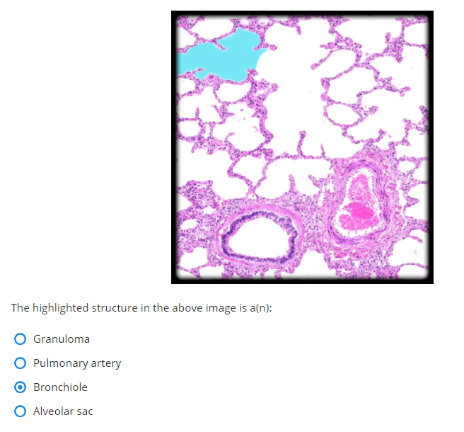 The highlighted structure in the above image is a(n):
Granuloma
Pulmonary artery
Bronchiole
Alveolar sac
