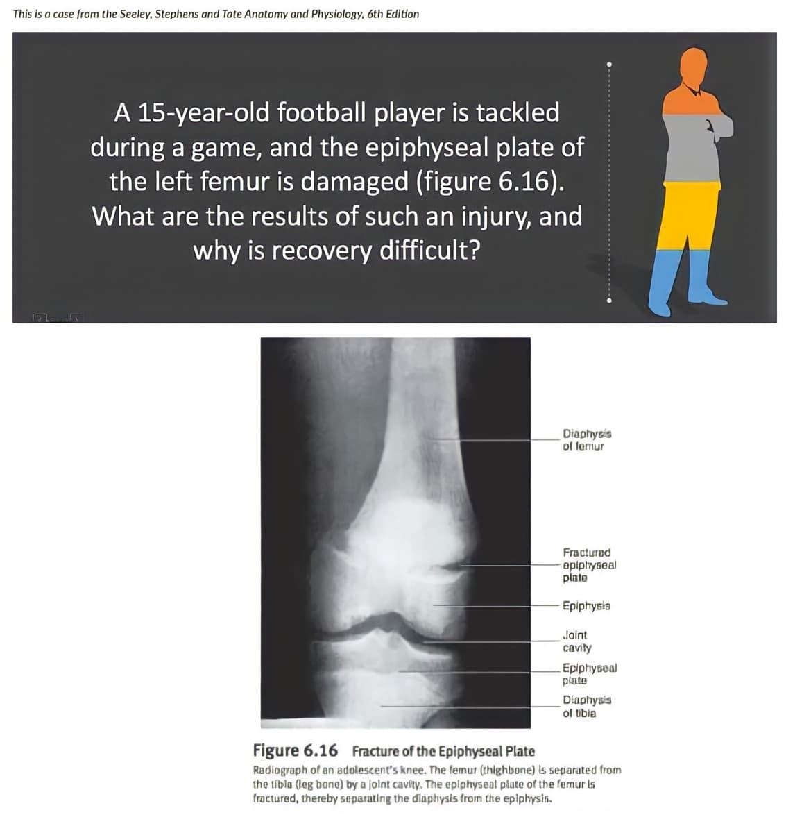 This is a case from the Seeley, Stephens and Tate Anatomy and Physiology, 6th Edition
A 15-year-old football player is tackled
during a game, and the epiphyseal plate of
the left femur is damaged (figure 6.16).
What are the results of such an injury, and
why is recovery difficult?
Diaphyris
of lemur
Fractured
eplphyseal
plate
Eplphysia
Joint
cavity
Epiphyseal
plate
Diaphysis
of tibla
Figure 6.16 Fracture of the Epiphyseal Plate
Radlograph of an adolescent's knee. The femur (thighbone) s separated from
the tibla (leg bane) by a Jolnt cavíty. The eplphysenl plate of the femur is
fractured, thereby separating the diaphysis from the epiphysis.
