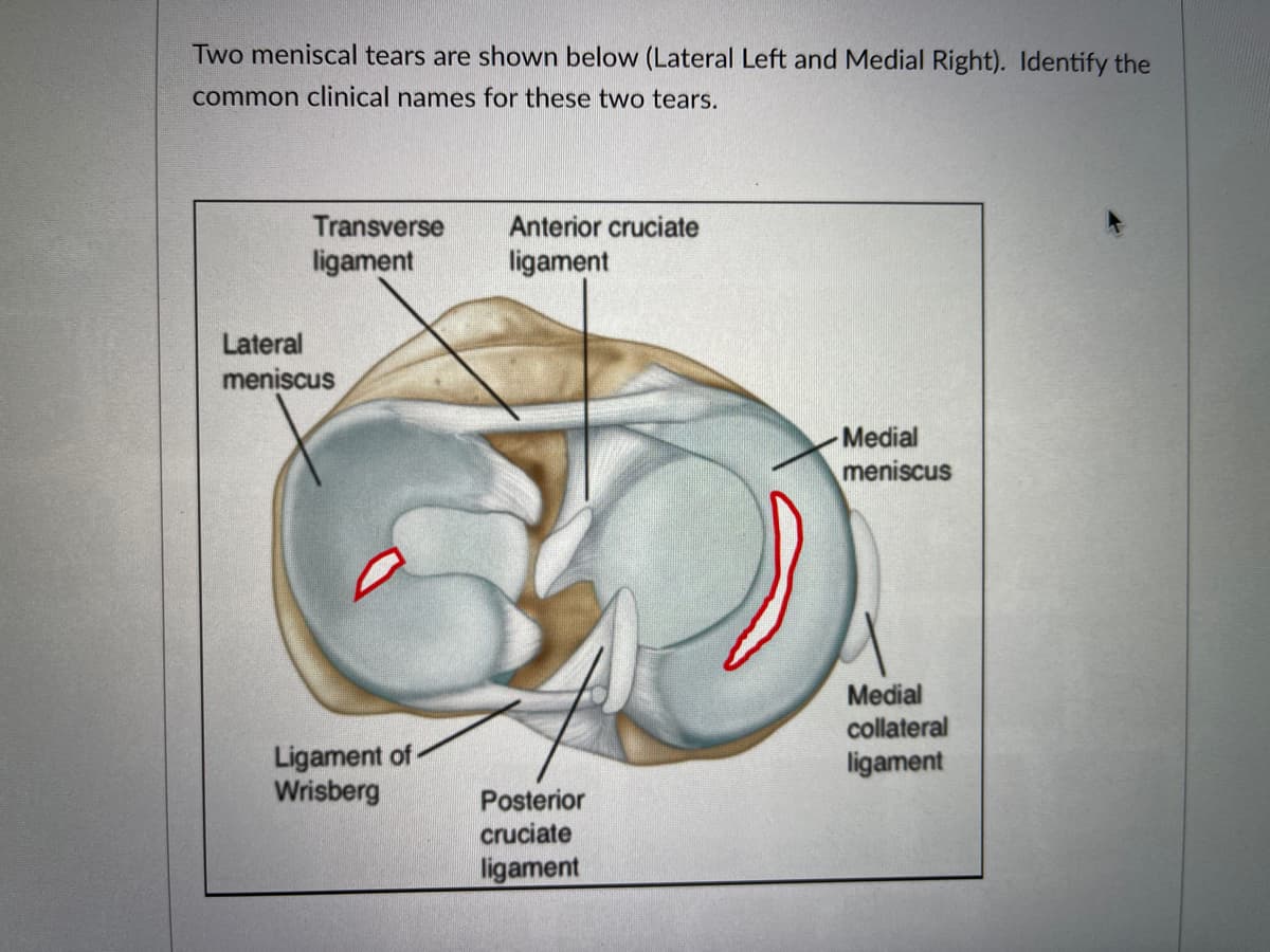 Two meniscal tears are shown below (Lateral Left and Medial Right). Identify the
common clinical names for these two tears.
Transverse
Anterior cruciate
ligament
ligament
Lateral
meniscus
Medial
meniscus
Medial
collateral
Ligament of-
Wrisberg
ligament
Posterior
cruciate
ligament
