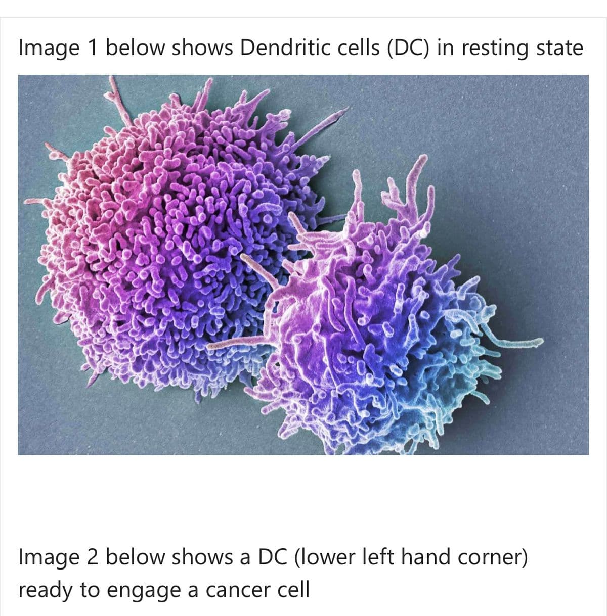 Image 1 below shows Dendritic cells (DC) in resting state
Image 2 below shows a DC (lower left hand corner)
ready to engage a cancer cell
