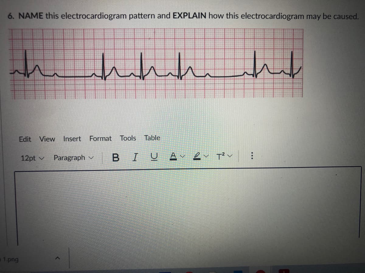 6. NAME this electrocardiogram pattern and EXPLAIN how this electrocardiogram may be caused.
the
Edit View Insert Format Tools
Table
12pt v
Paragraph v
BIU A
v ev T? v
1.png
...
