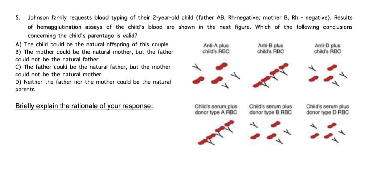 Johnson family requests blood typing of their 2-year-old child (father AB, Rh-negative; mother B, Rh negative). Results
of hemagglutination assays of the child's blood are shown in the next figure. Which of the following conclusions
concerning the child's parentage is valid?
A) The child could be the natural offspring of this couple
B) The mother could be the natural mother, but the father
I could not be the natural father
5.
C) The father could be the natural father, but the mother
I could not be the natural mother
D) Neither the father nor the mother could be the natural
parents
Briefly explain the rationale of your response:
Anti-A plus
child's RBC
Child's serum plus
donor type A RBC
Anti-B plus
child's RBC
Child's serum plus
donor type B RBC
Anti-D plus
child's RBC
Child's serum plus
donor type D RBC