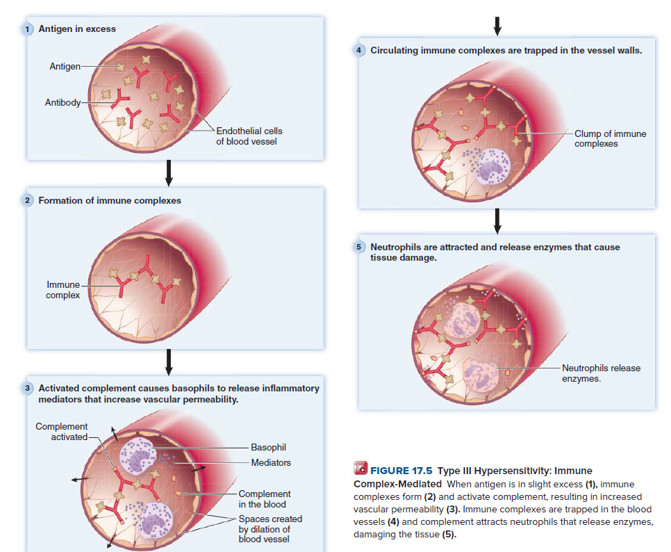 1 Antigen in excess
4 Circulating immune complexes are trapped in the vessel walls.
Antigen-
Antibody-
Endothelial cells
Clump of immune
complexes
of blood vessel
2 Formation of immune complexes
Neutrophils are attracted and release enzymes that cause
tissue damage.
Immune
complex
Neutrophils release
enzymes.
Activated complement causes basophils to release inflammatory
mediators that increase vascular permeability.
Complement
activated
Basophil
Mediators
O FIGURE 17.5 Type III Hypersensitivity: Immune
Complex-Medlated When antigen is in slight excess (1), immune
complexes form (2) and activate complement, resulting in increased
vascular permeability (3). Immune complexes are trapped in the blood
vessels (4) and complement attracts neutrophils that release enzymes,
damaging the tissue (5).
Complement
in the blood
Spaces created
by dilation of
blood vessel
