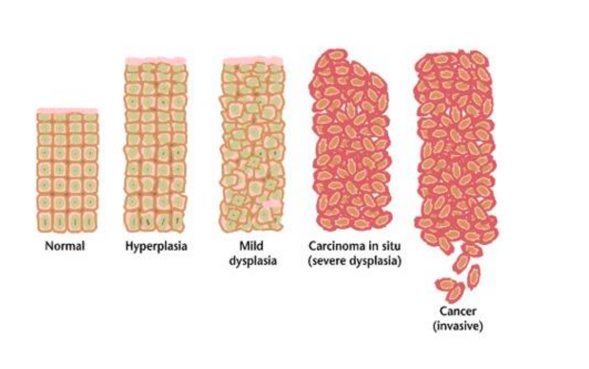 Normal
Hyperplasia
Mild
Carcinoma in situ
dysplasia
(severe dysplasia)
Cancer
(invasive)
