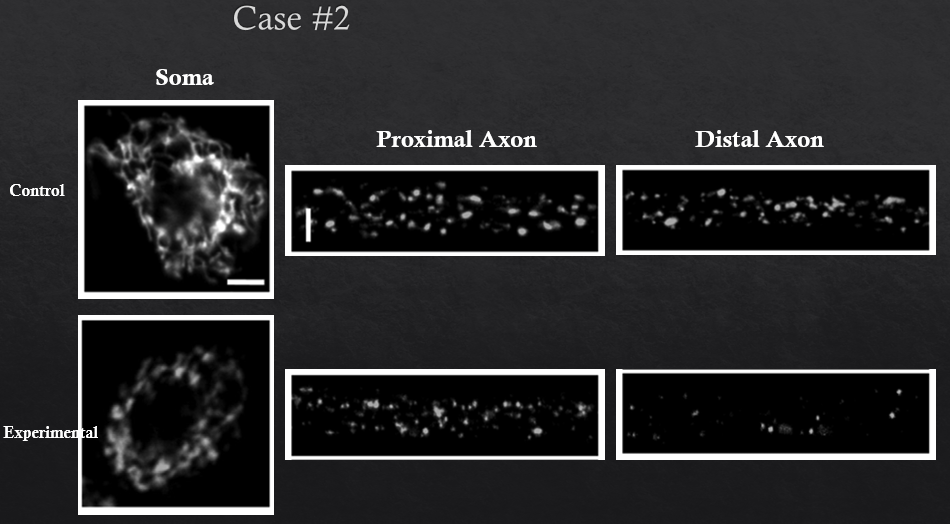 Case #2
Soma
Proximal Axon
Distal Axon
Control
Experimental
