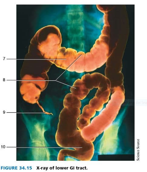 7
10
FIGURE 34.15 X-ray of lower GI tract.
Science Source
