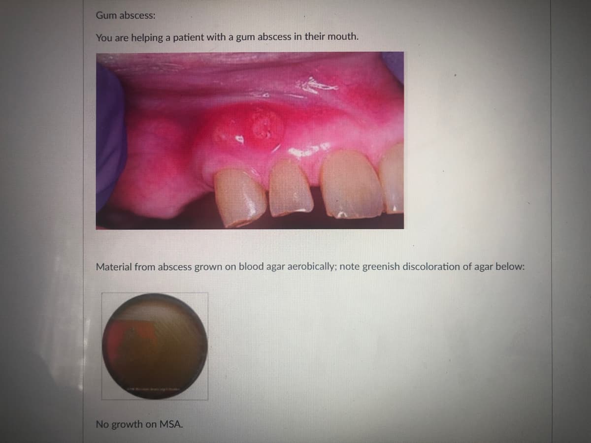Gum abscess:
You are helping a patient with a gum abscess in their mouth.
Material from abscess grown on blood agar aerobically; note greenish discoloration of agar below:
No growth on MSA.
