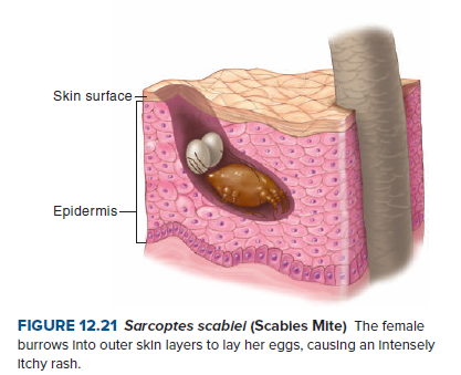 Skin surface-
Epidermis-
FIGURE 12.21 Sarcoptes scablel (Scables Mite) The female
burrows Into outer skin layers to lay her eggs, causing an Intensely
Itchy rash.
